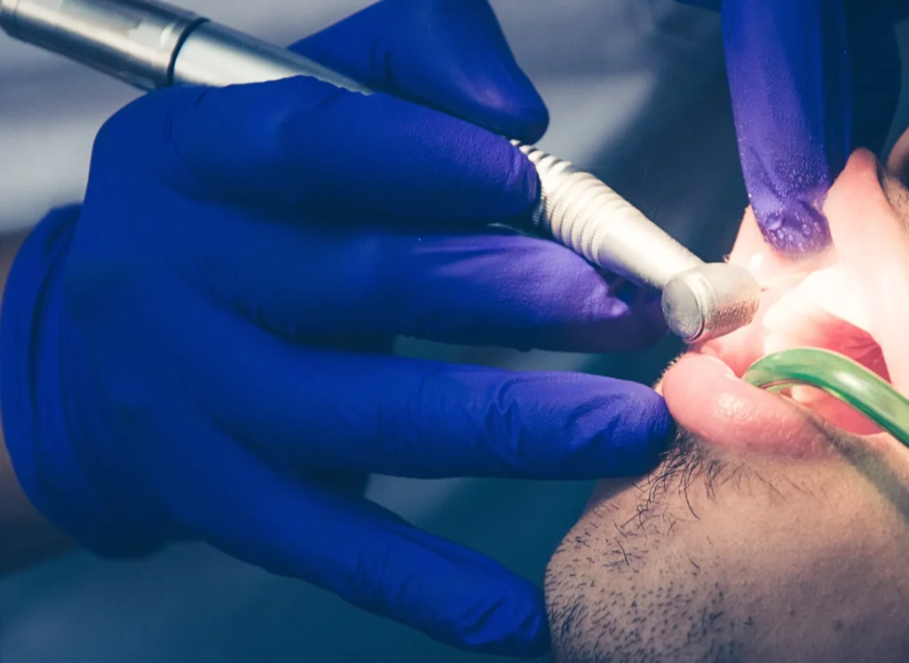 Ogni quanto fare la pulizia dentale
