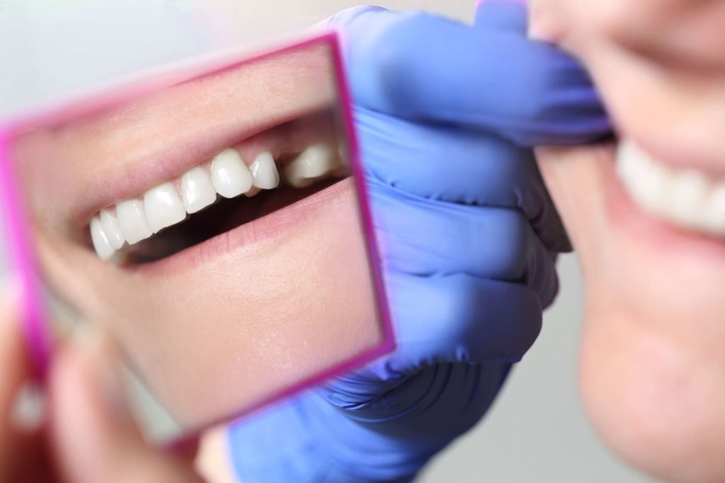 Cosa mangiare dopo un impianto dentale: guida pratica al post-intervento 1 Cosa mangiare dopo un impianto dentale