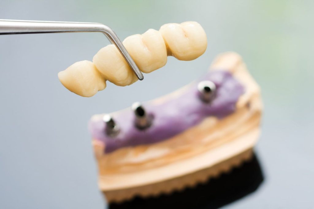 Come si fa un impianto dentale 1 Come si fa un impianto dentale