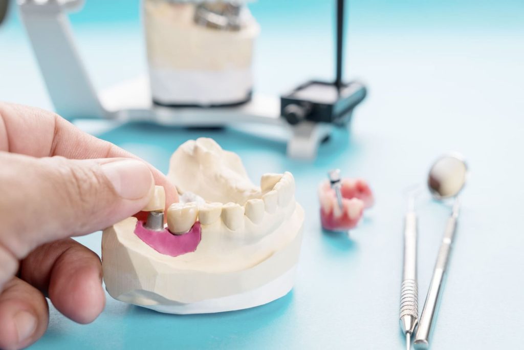 Quanto dura un impianto dentale? Tutto sulla durata, la manutenzione e i fattori che la influenzano 1 Quanto dura un impianto dentale