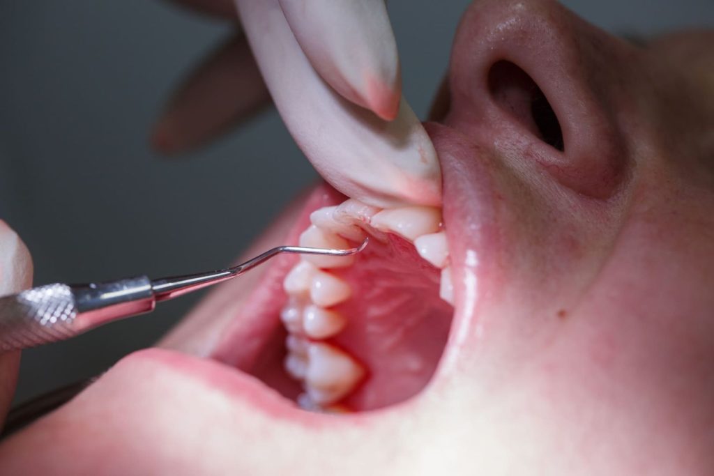 Come curare la gengivite: consigli e trattamenti dal dentista 1 Come curare la gengivite